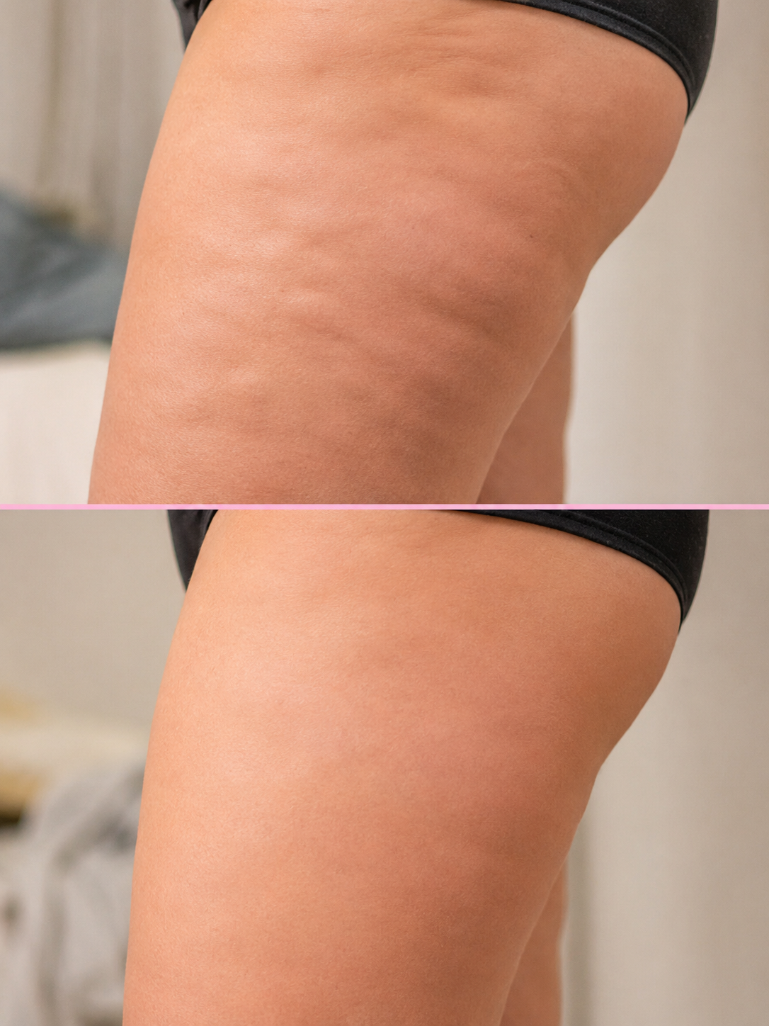 Before and after showing visibly smoother, firmer skin after following the Cellulite Fix programme